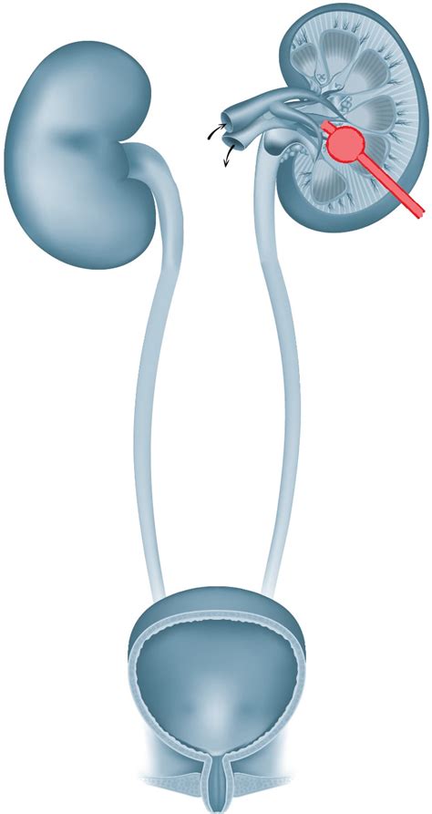 Nephrostomie 